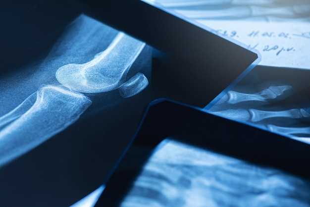 Рак кости на рентгене: особенности визуального обозначения