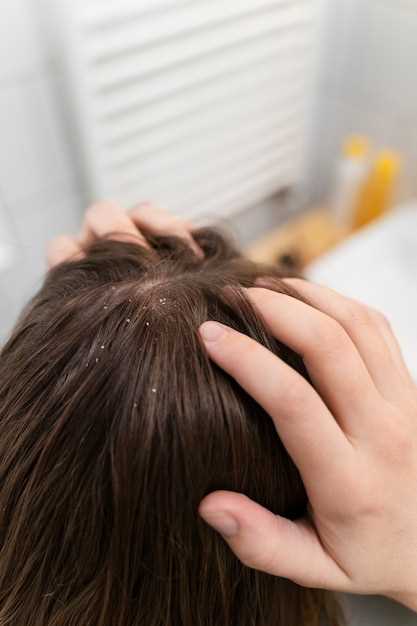 Главные причины сухости кожи головы и как с ними бороться